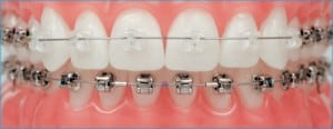 Brackets-tratamientos-de-ortodoncia
